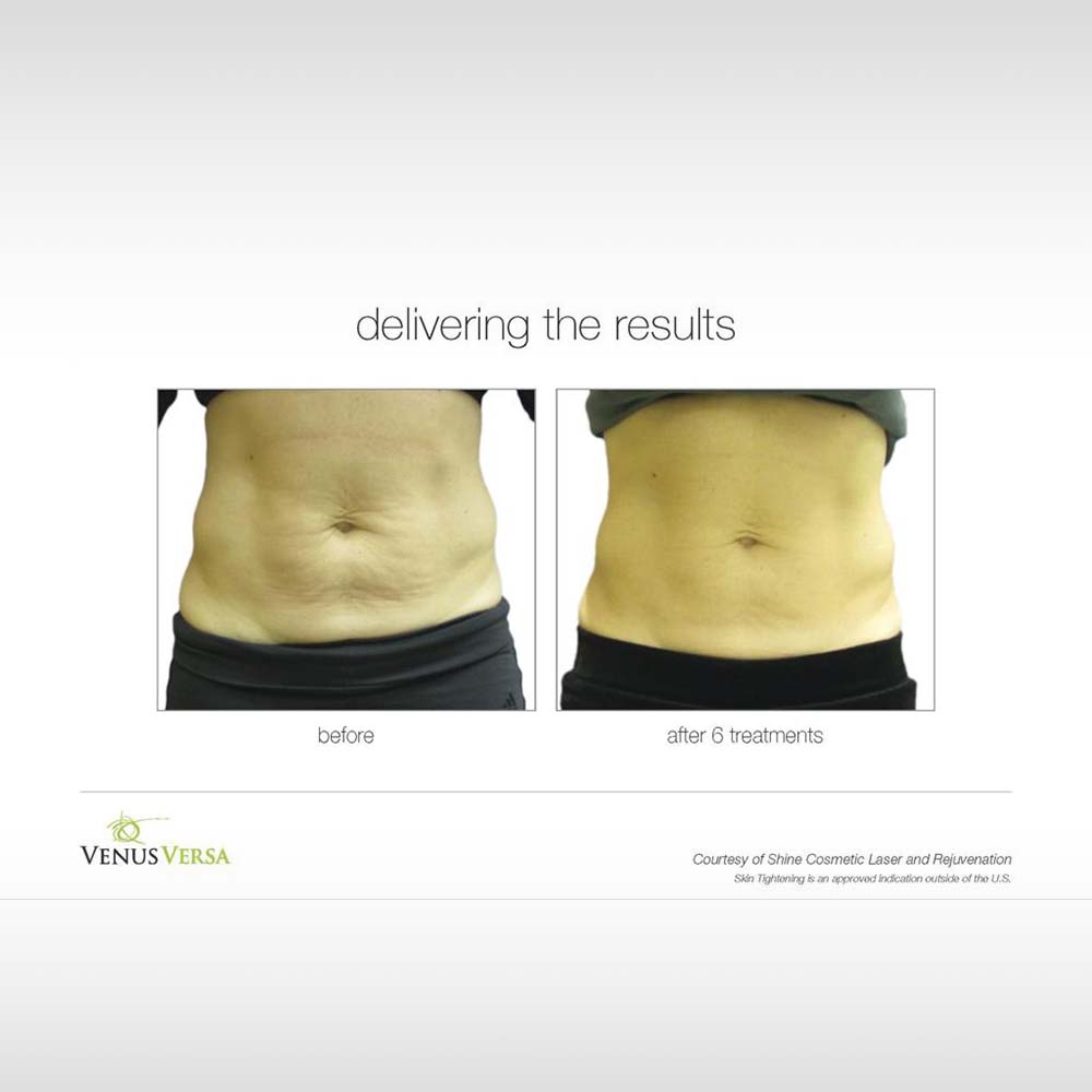 Anti-Cellulite-Body-Contouring-05