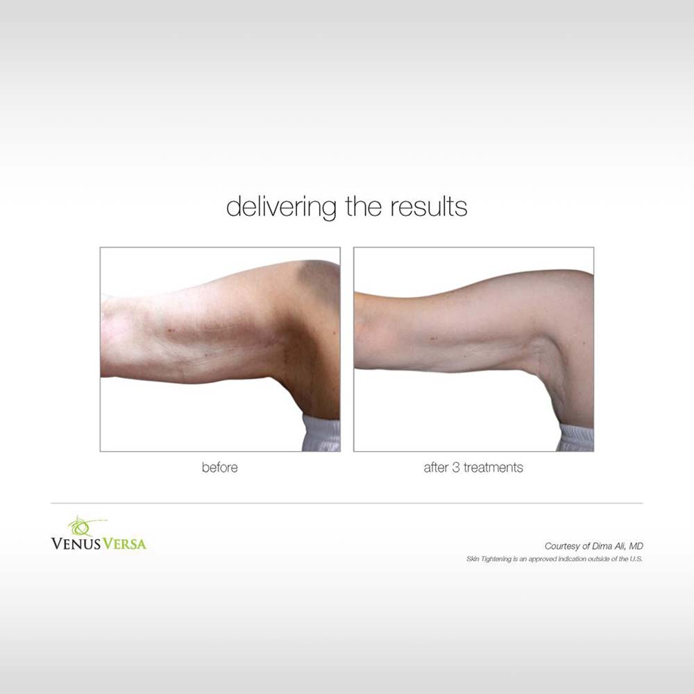 Anti-Cellulite-Body-Contouring-06