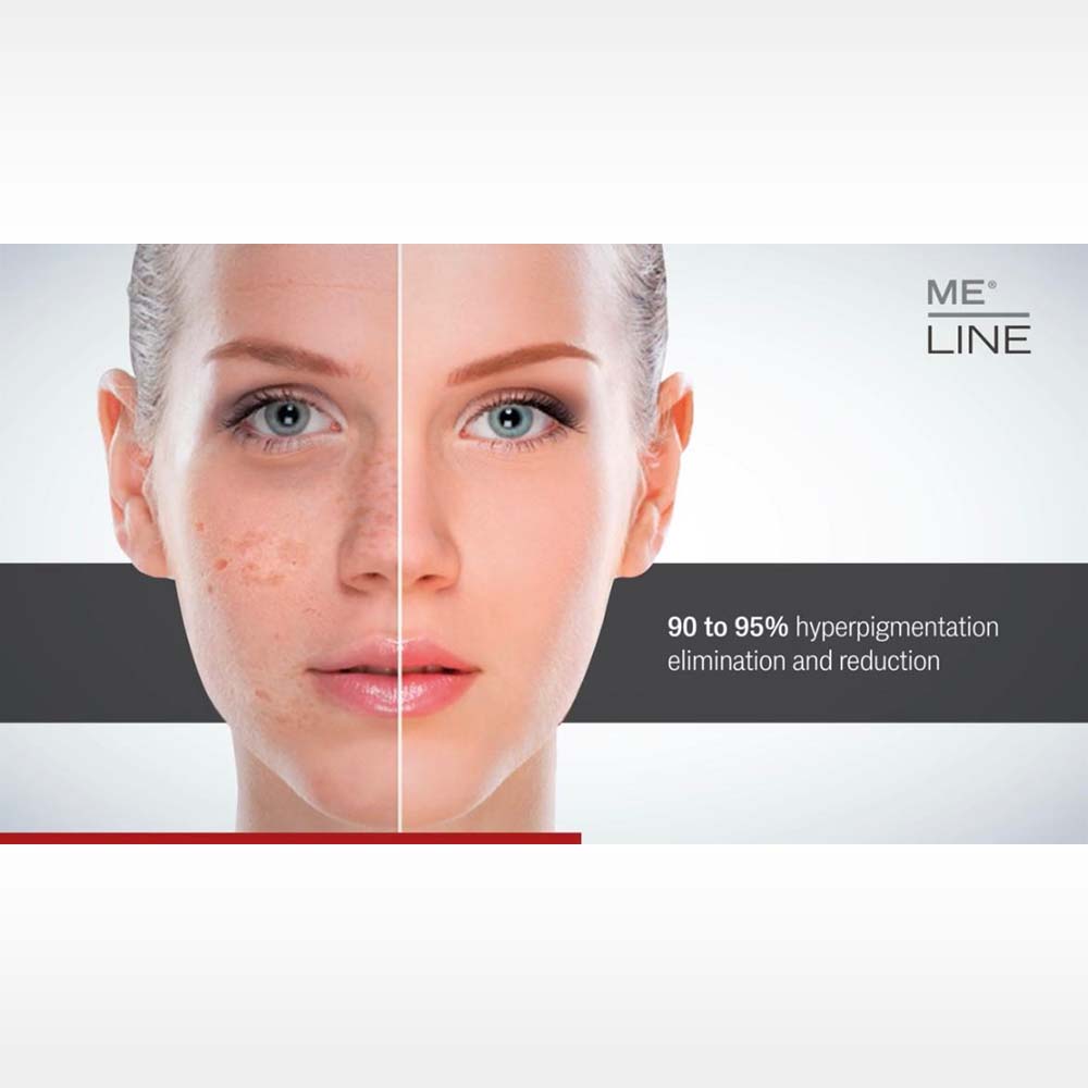 ME LINE-skin-depigmentation-06
