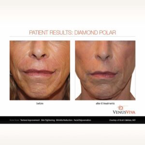 Radio-Frequency-skin-tightening-03