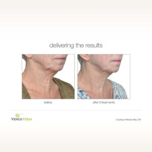 Radio-Frequency-skin-tightening-04