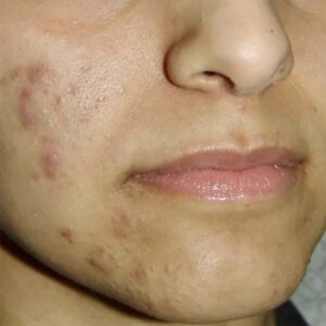 acne-01