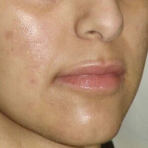 acne-02