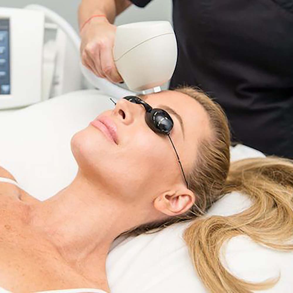 IPL photofacial-01