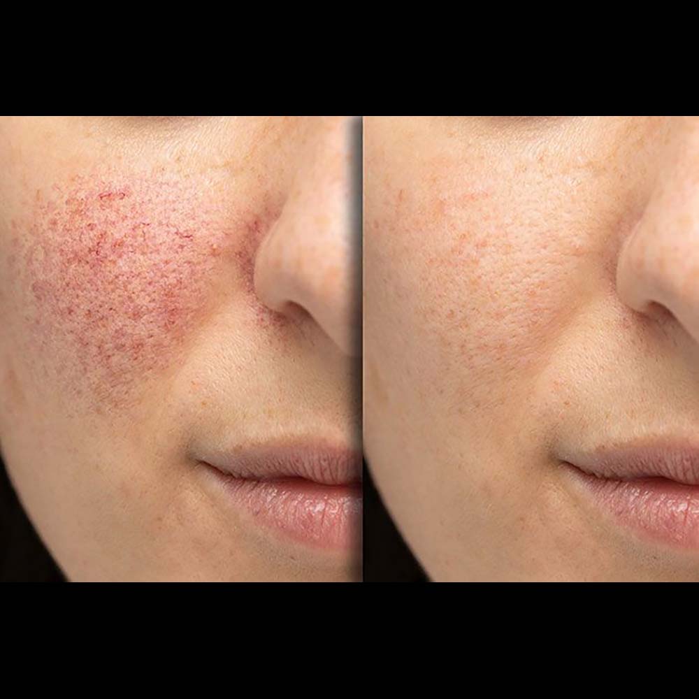 IPL photofacial-03