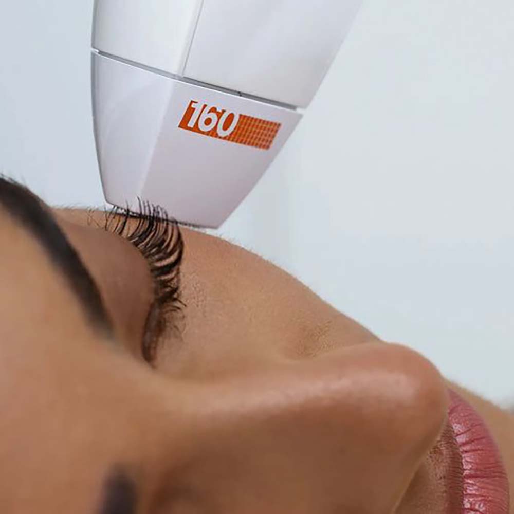 Skin resurfacing1