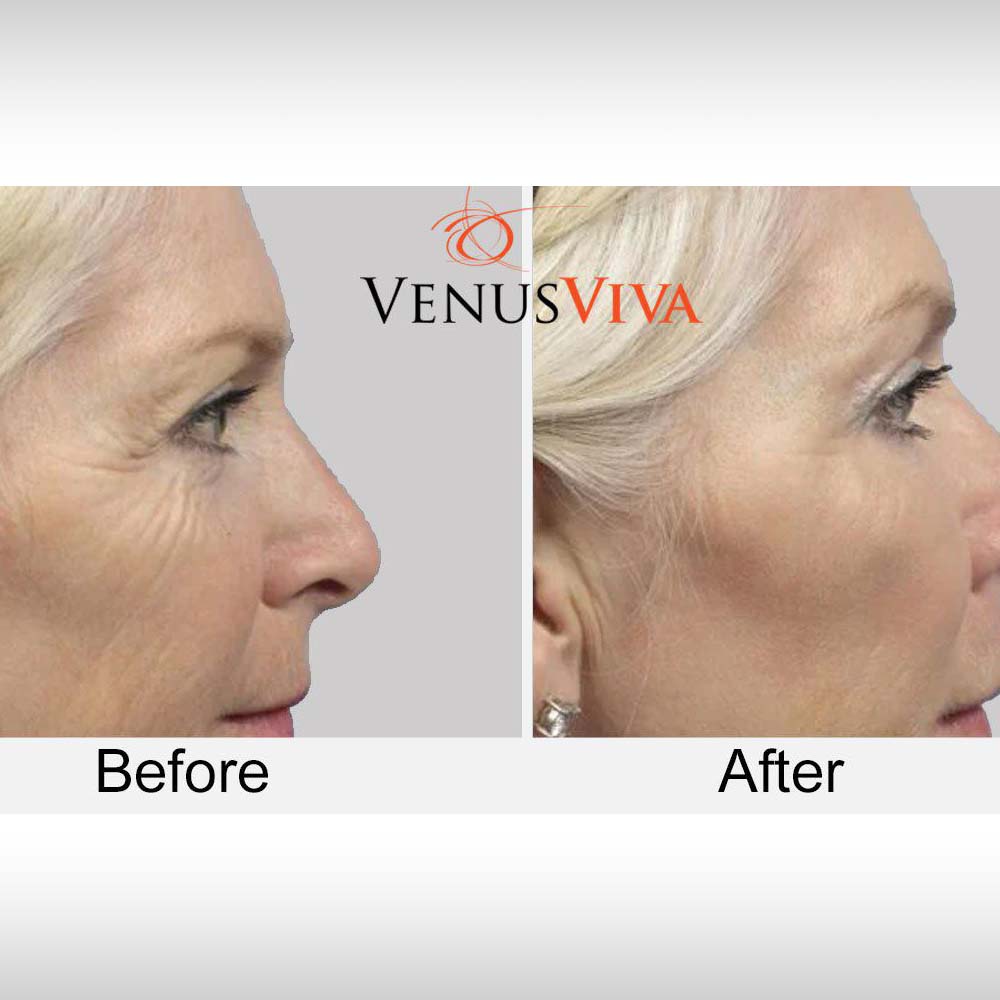 Skin resurfacing4