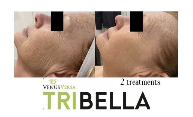 Tri bella1