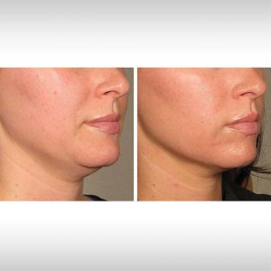 NIR skin tightening03